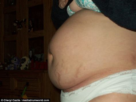 Aylesbury Mum Looks Pregnant After Botched Nhs C Section Daily Mail