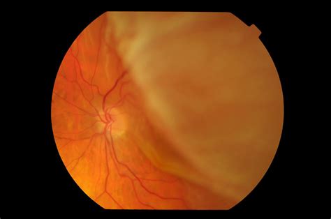Retinal Tear Or Detachment — Strathfield Retina Clinic