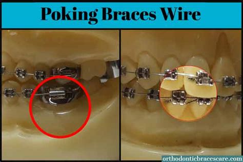 Braces Wire Popped Out Of Bracket How To Fix Orthodontic Braces Care
