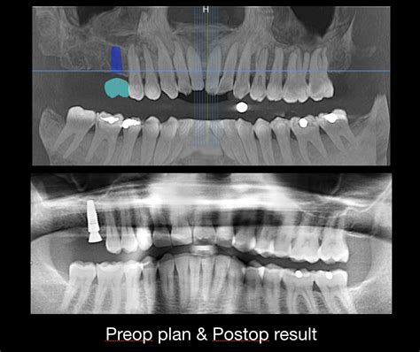 Guided Implant Surgery David C Stahr Dds Oral Surgery — Stahr Oral
