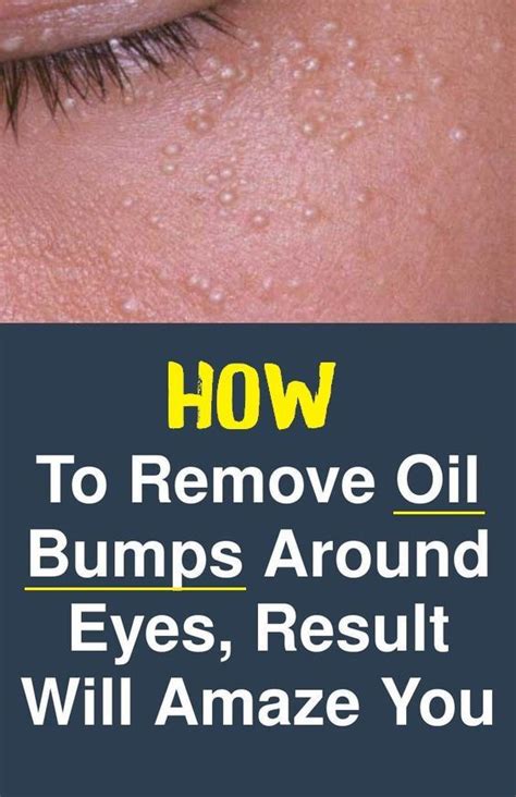How To Get Rid Of Those Little Oil Bumps On The Face Small Bumps On