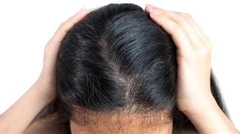 Effect Of Scalp Health On Hair Growth Medesthetics
