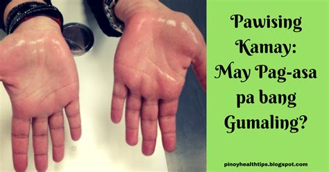 Pawising Kamay May Pag Asa Pa Bang Gumaling Pinoy Health Tips