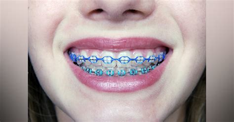 Braces Cost In South Africa 2022
