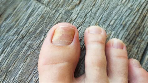 10 Best Essential Oils For Toenail Fungus 2023 Guide And Review