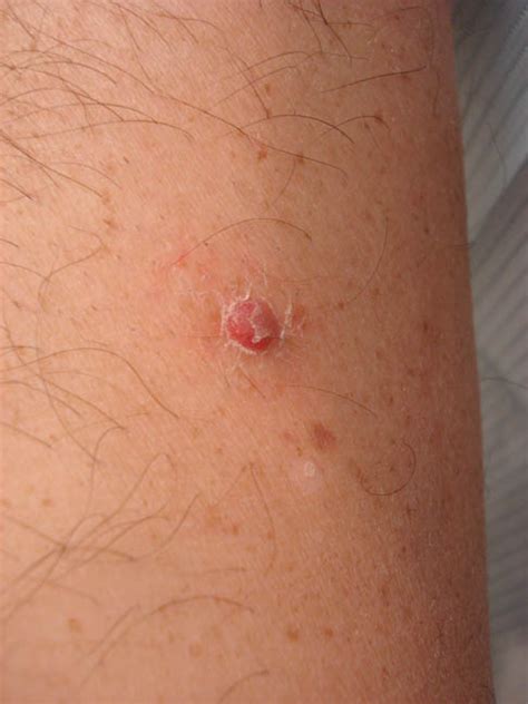 Types Skin Cancer Lesions