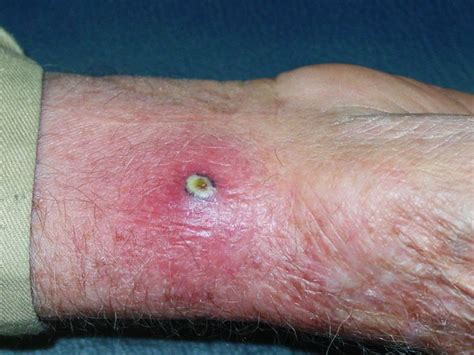 9 Best Mrsa Images On Pinterest Day Care Health And Health Care