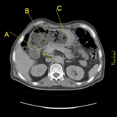 Abdominal Computed Tomography Scan Axial Section Showing A