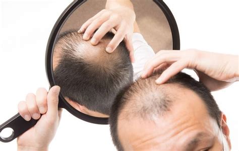 Cómo Recuperar El Pelo Alopecia Coronilla Iqc