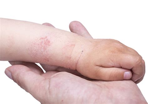 8 Ways To Help Children With Eczema Reduce Itchiness Health Health