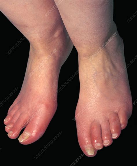 Erythromelalgia Of The Feet Stock Image C0515010 Science Photo