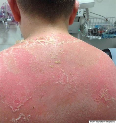 Mum Of Teen Who Suffered Severe Sunburn On School Trip Says Teachers