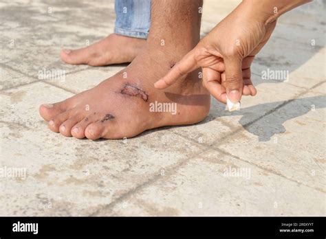 Close Up Of Showing An Semi Dried Wound On The Left Feet Of A Man With