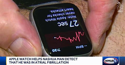 Apple Watch Series 4 ตรวจพบภาวะ Afib จากการวัดคลื่นไฟฟ้าหัวใจ Ecg ใน