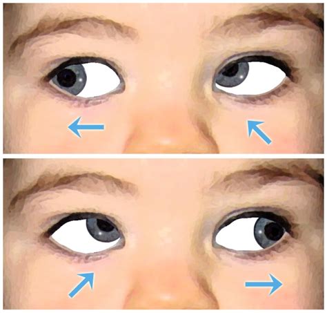 Hyperfunction Of The Inferior Oblique Muscle A Childs Eyes Athens