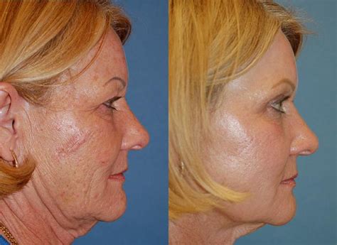 Patient 122406490 Laser Assisted Weekend Neck Lift Before And After