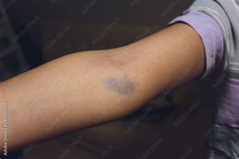 Bruises From Blood Collection Isolated Purple Bruise On The Arm Foto
