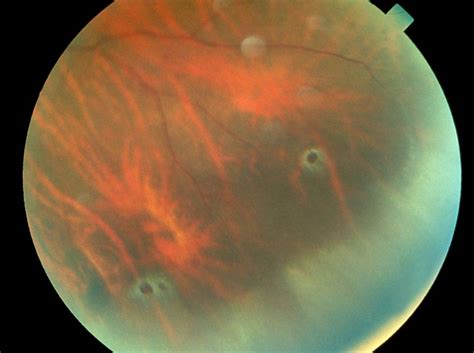 Atrophic Retinal Hole Picture A Pictures Of Hole 2018