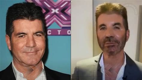 Simon Cowell Before And After Plastic Surgery What Happened To His Face
