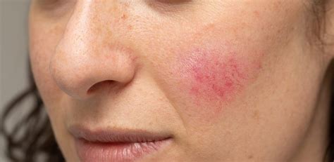Acne Rosacea Skin Care Treatment Itcgap