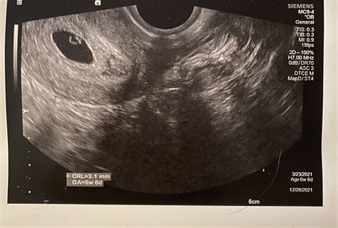 First Ultrasound Measuring Behind Pics Inside Babycenter