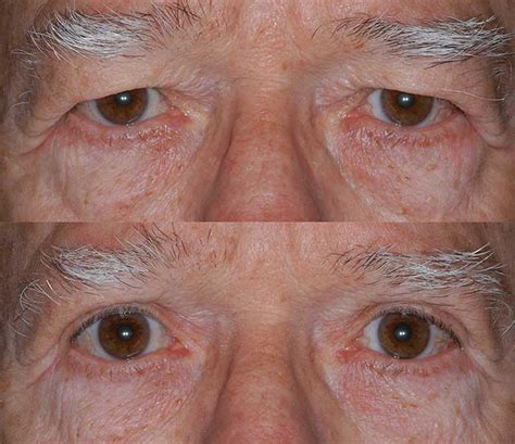 We did not find results for: Eyelid Surgery Miami | Blepharoplasty Miami | CEEC