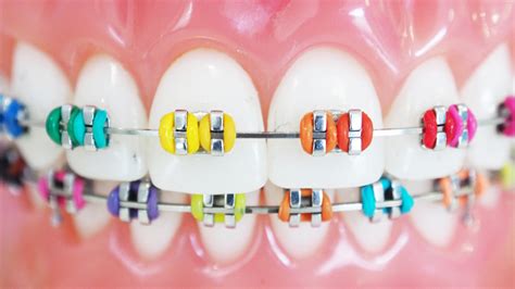 braces colors for teeth