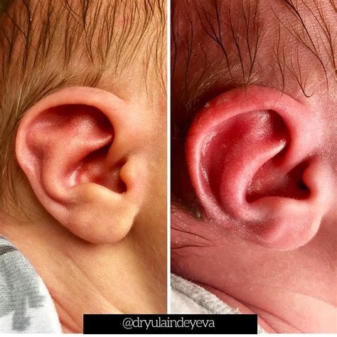 Newborn Ear Deformity Correction Newborn Child Newborn Save The
