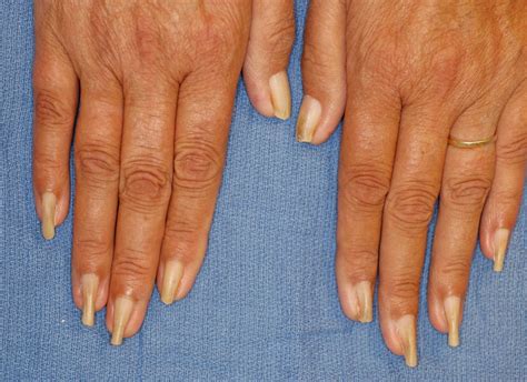 Acquired Pincer Nail Deformity Associated With End Stage Renal Disease