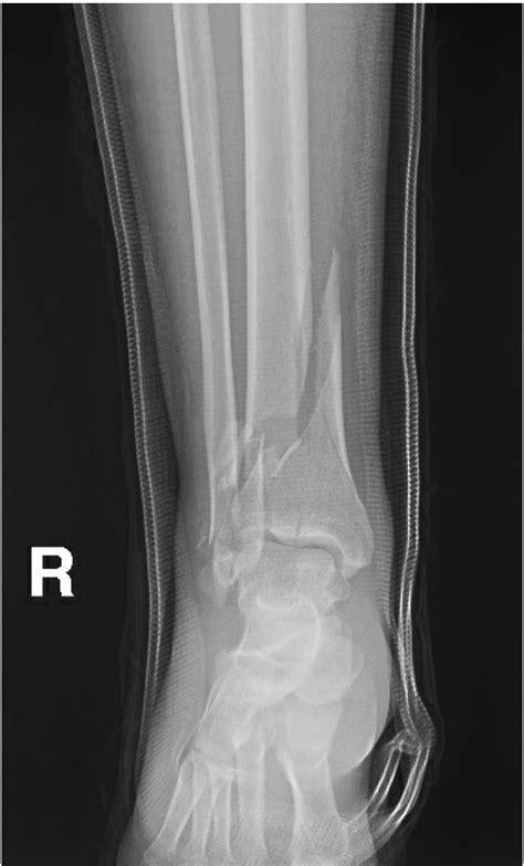 Ortho Pearls Tibial Plafond Fracture — Cook County Emergency Medicine