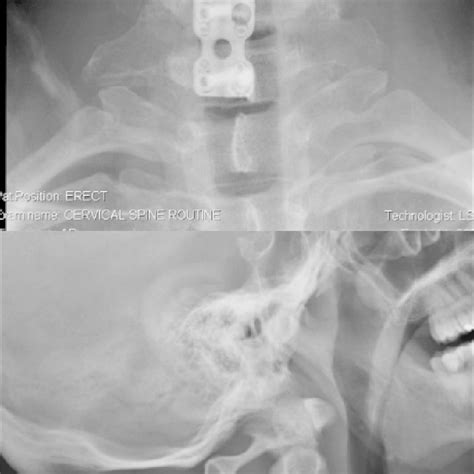 Plain Radiographs Showing The Postoperative Top Anteroposterior And