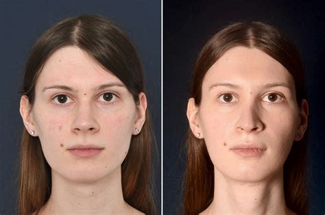 facial feminization software free voper