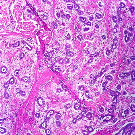 Fibroadenoma Breast Microscope Slide