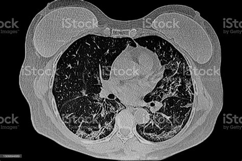 Chest Ct Scan Of Female Patient With Breast Protesis And Lung Infection