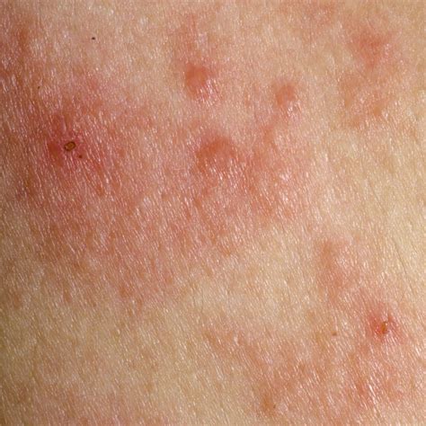 Eczema Atopic Dermatitis Symptom Skin Eczema Treatment Chronic Hives