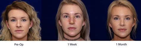 Image Result For Day By Day Rhinoplasty Recovery Rhinoplasty Recovery