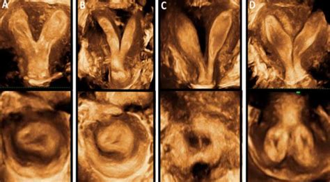 figure 2 from role of three dimensional ultrasound in uterine anomalies 3d assessment of
