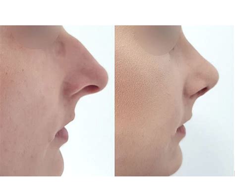 Korekcja Nosa Chirurgia Plastyczna Dr Nawrocki
