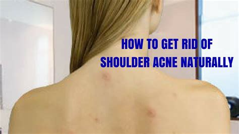 HOW TO GET RID OF SHOULDER ACNE NATURALLY YouTube