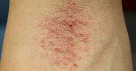 Reshape Life Eczema The Itch That Keeps On Itching