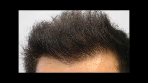 Widows Peak In Transplanted Hairline Honest Client Review Youtube