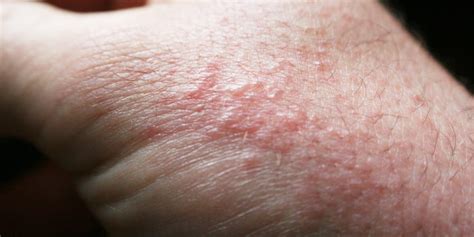 Poison Oak Rash Symptoms Treatment And When To See A Doctor