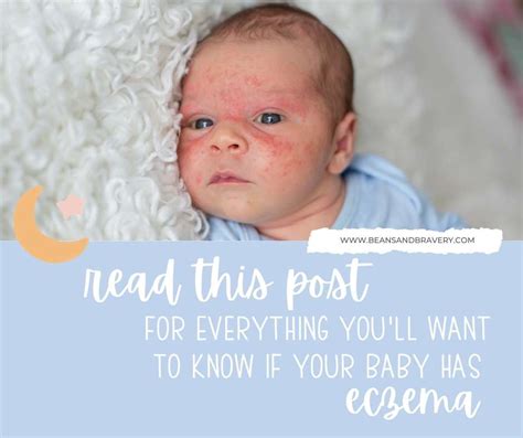 Everything You Need To Know If You Have A Baby With Eczema Beans