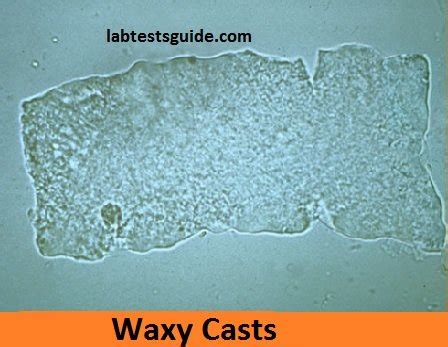 Urinery Casts Types Results And Clinical Significations Lab Tests Guide