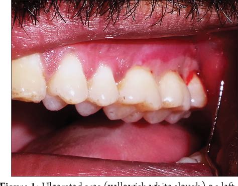 Pdf Acute Herpetic Gingivostomatitis Associated With Herpes Simplex