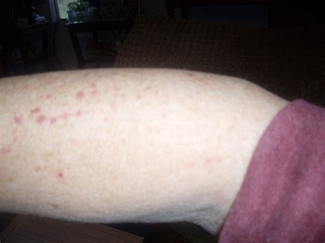 Identifying Red Spots On Arm Thriftyfun