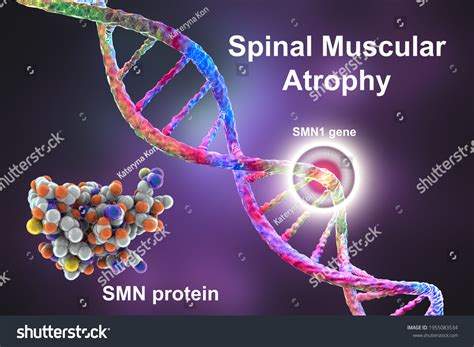 Spinal Muscular Atrophy Sma Genetic Neuromuscular Stock Illustration