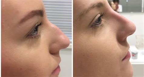 Non Surgical Rhinoplasty A Painless Way To Achieve A Desired Look In Beverly Hills Idef