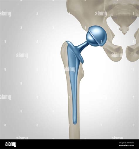 Hip Replacement Surgery Concept As An Artificial Joint Or Prosthesis