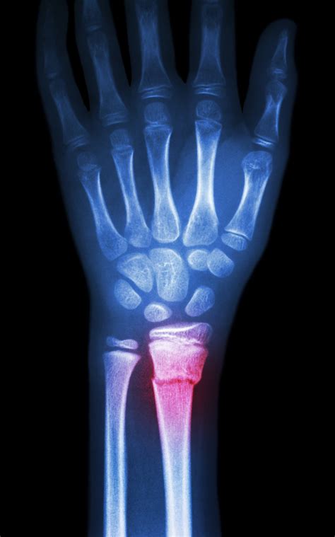 Most Common Fracture Wrist